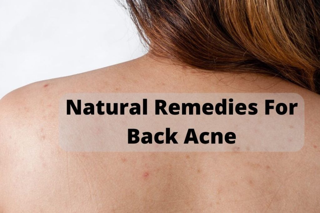 treatments for back acne