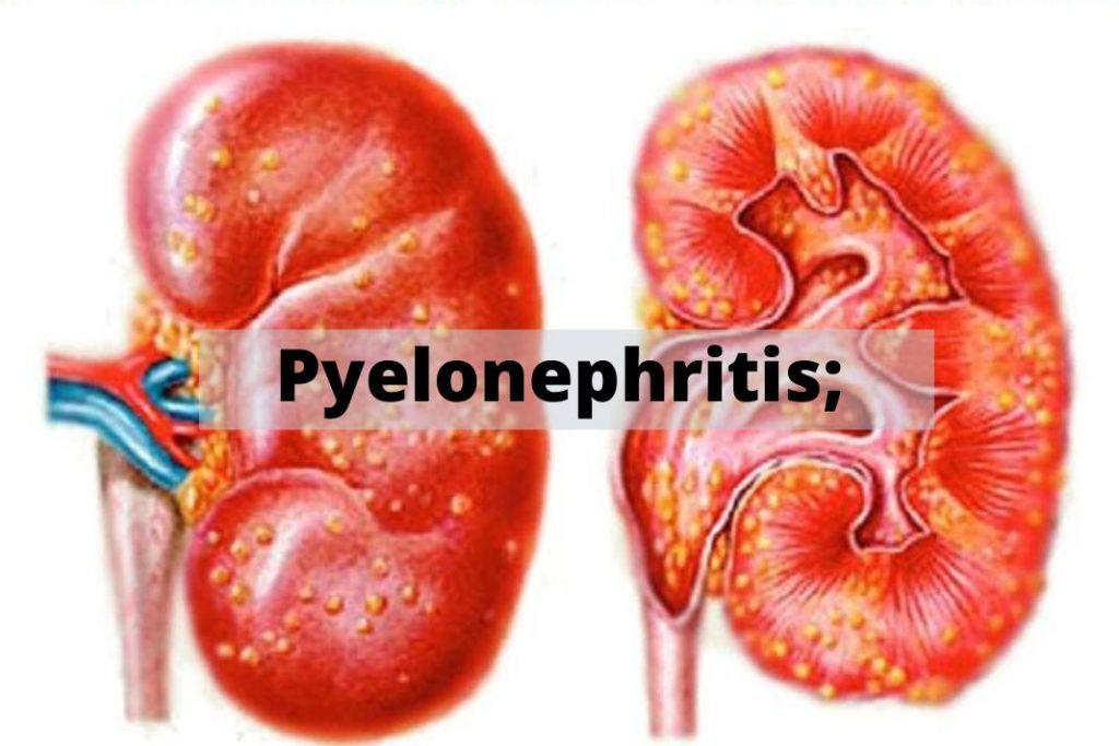 Pyelonephritis