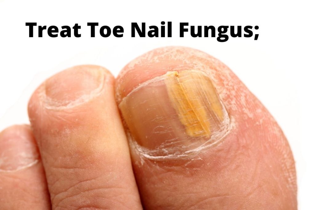 Toe Nail Fungus