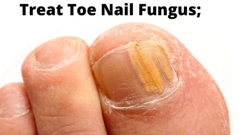Toe Nail Fungus
