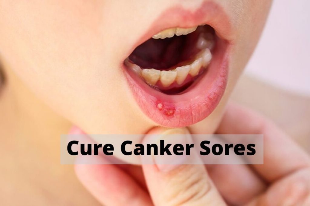 Cure Canker Sores