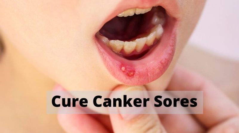 Cure Canker Sores