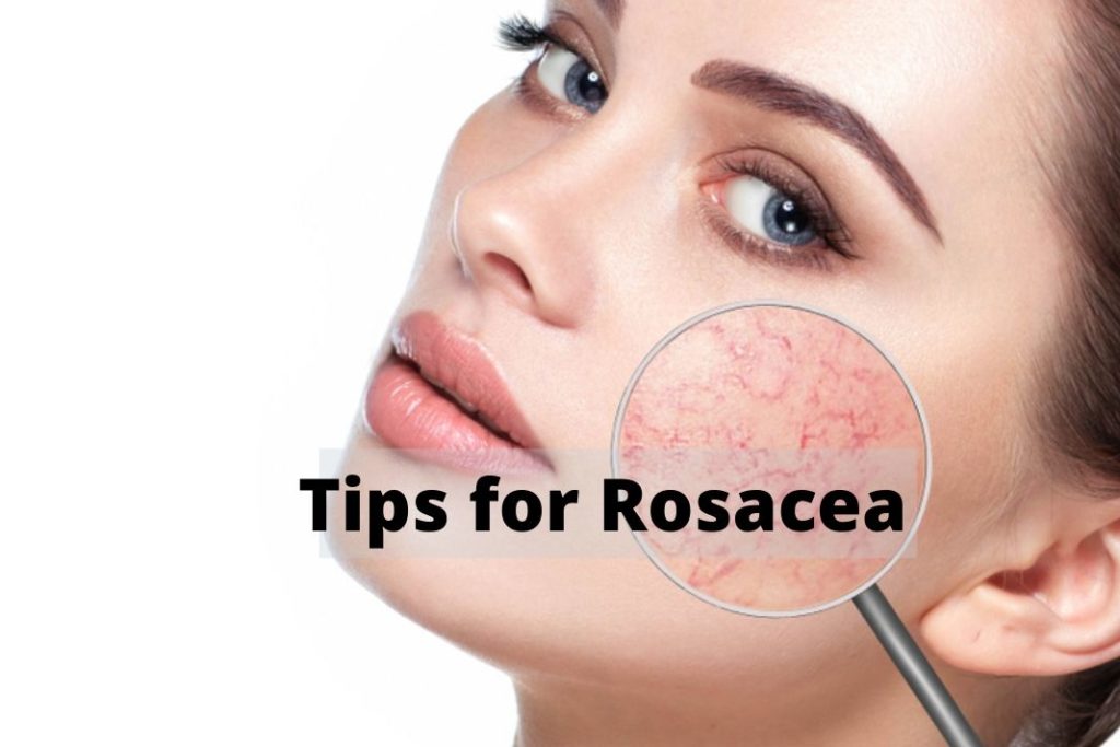 tips for rosacea