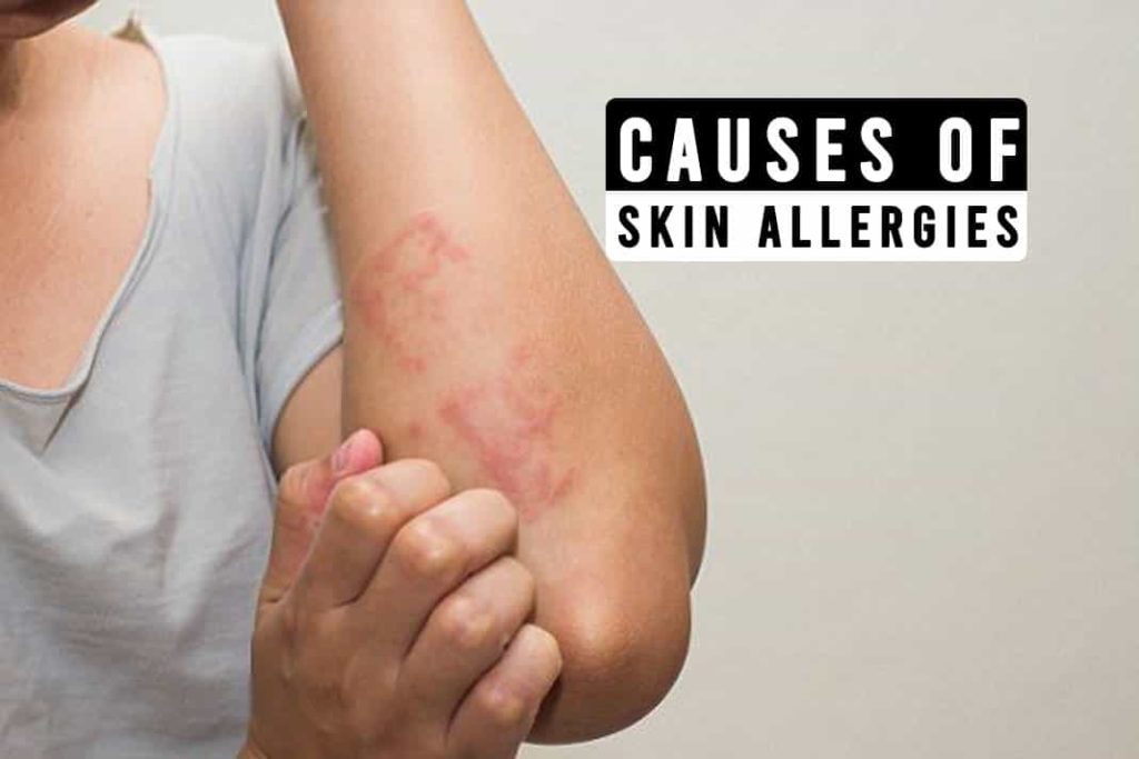 Causes of Skin Allergies