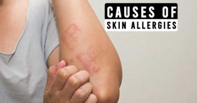 Causes of Skin Allergies