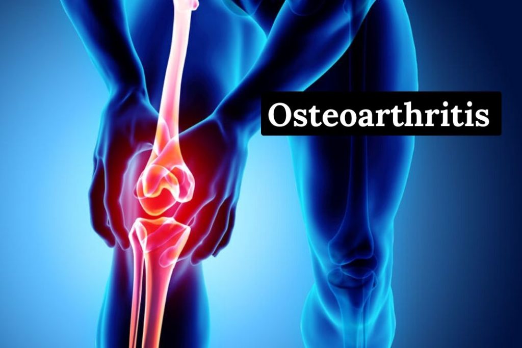 osteoarthritis