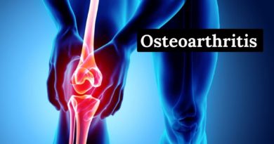 osteoarthritis