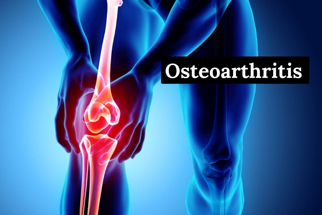 Osteoarthritis Symptoms, Treatments, and Causes Go Lifestyle Wiki