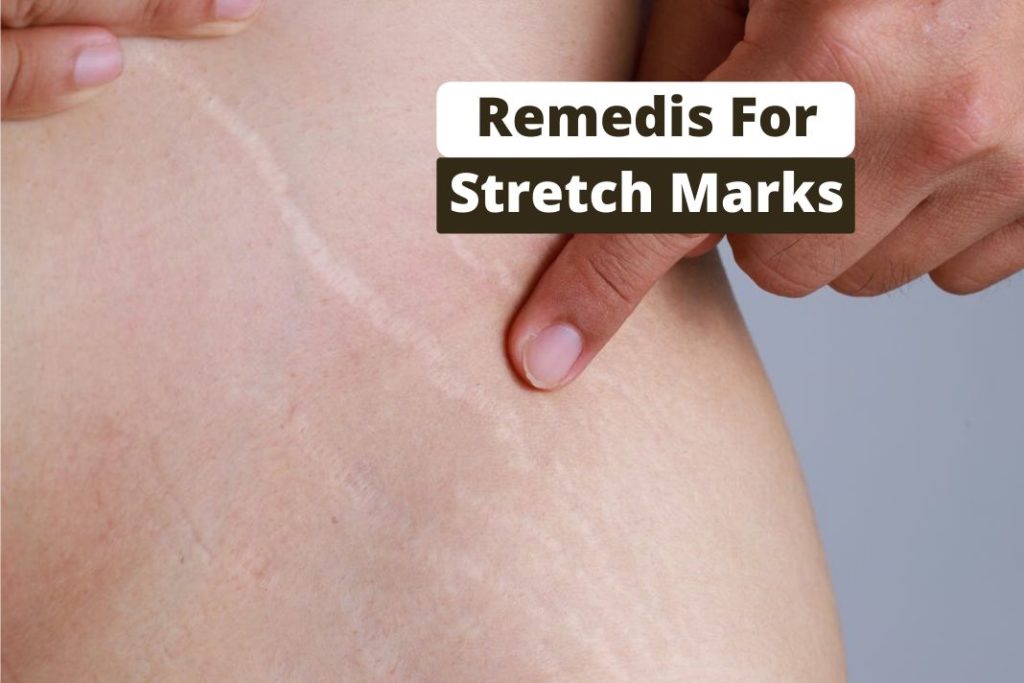 remedies for Stretch Marks