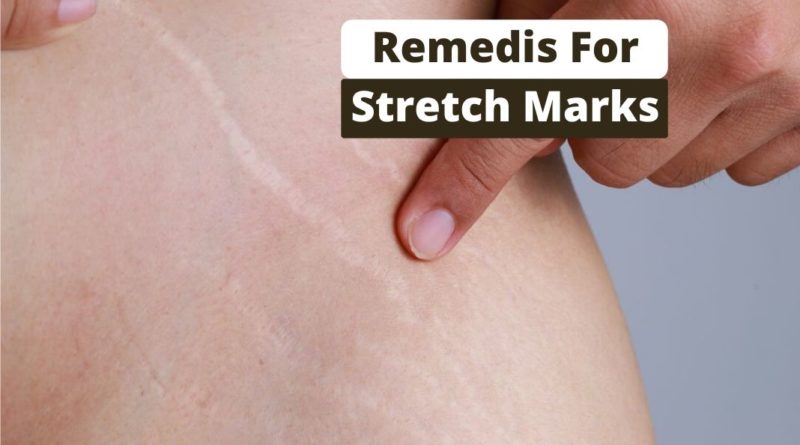 remedies for Stretch Marks