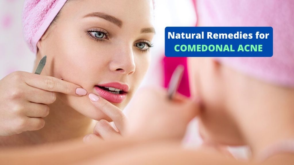 Natural Remedies for Comedonal Acne