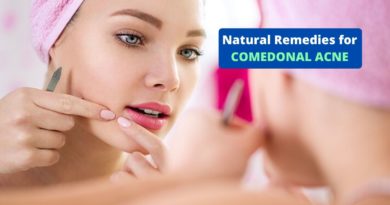 Natural Remedies for Comedonal Acne