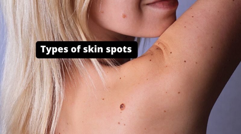 Types of skin spots