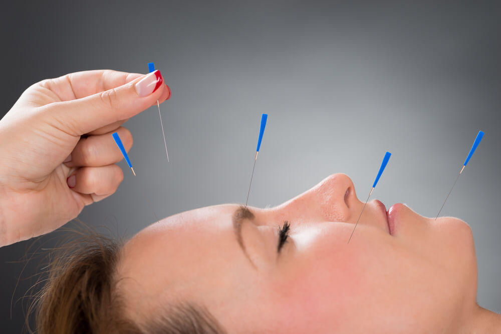 Acupuncture on face