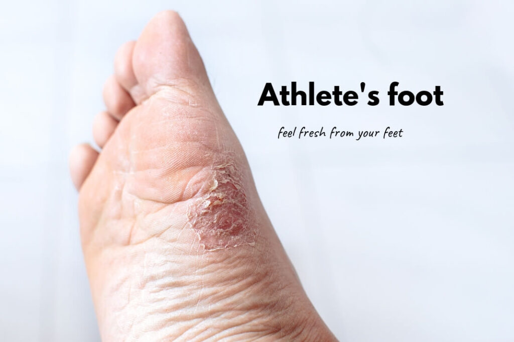 Athletes foot