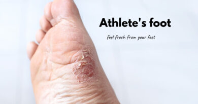 Athletes foot