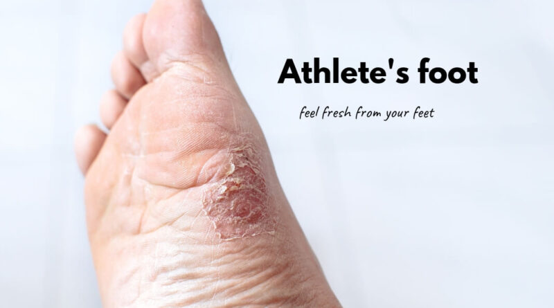 Athletes foot