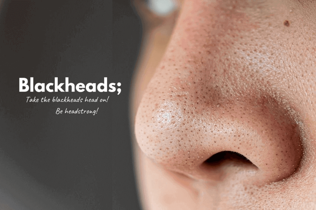 Blackheads