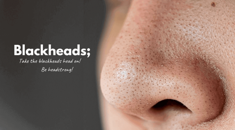 Blackheads