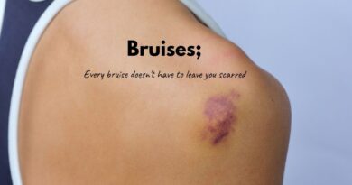 Bruises