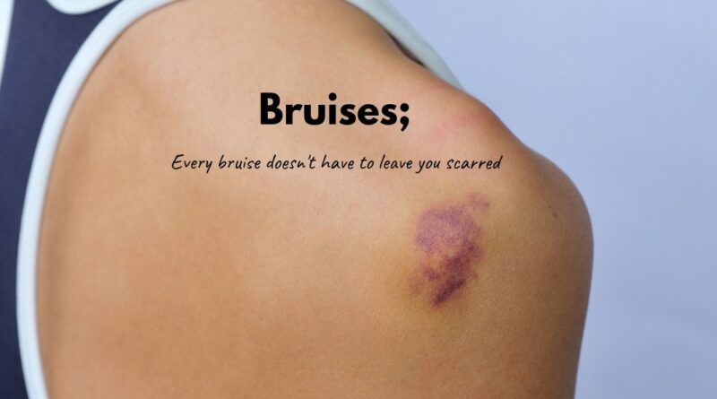 Bruises