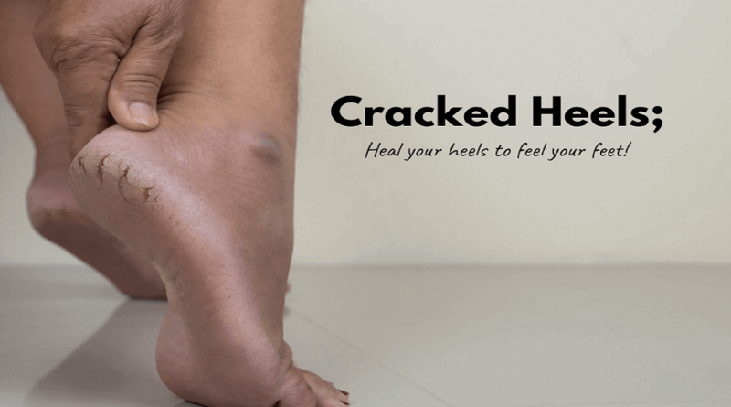 Cracked Heels