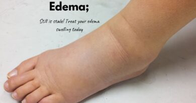 Edema