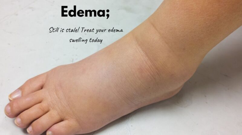 Edema