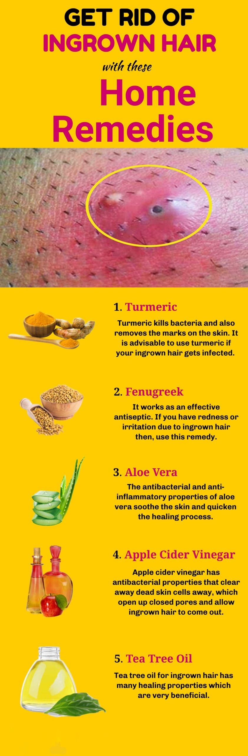 Get Rid Of Ingrown Hair Infographic scaled