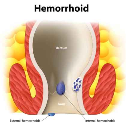 Hemorrhoids types