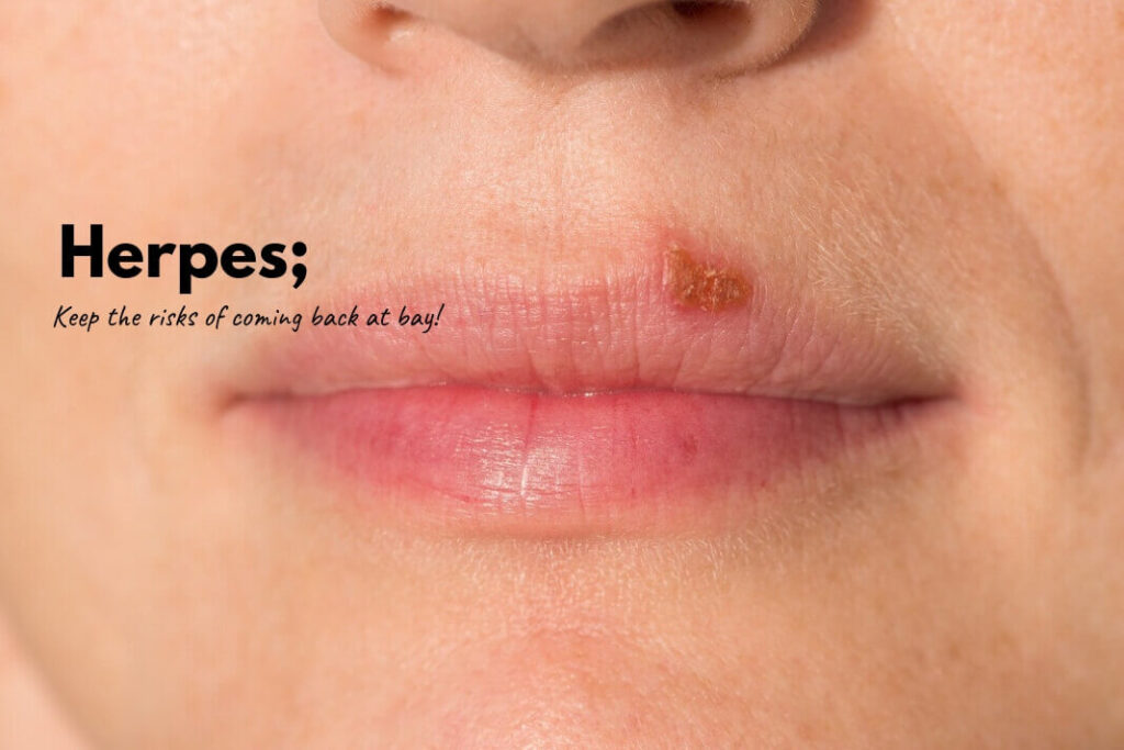 How to Treat Herpes