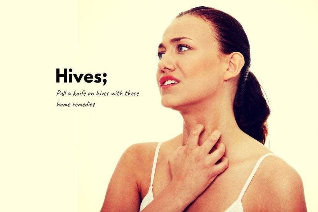 How to get rid of Hives