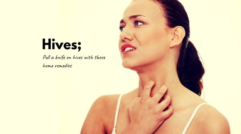 How to get rid of Hives