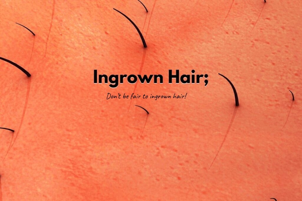 Ingrown Hair