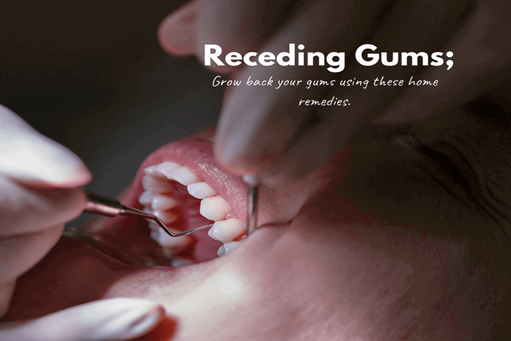 Receding Gums