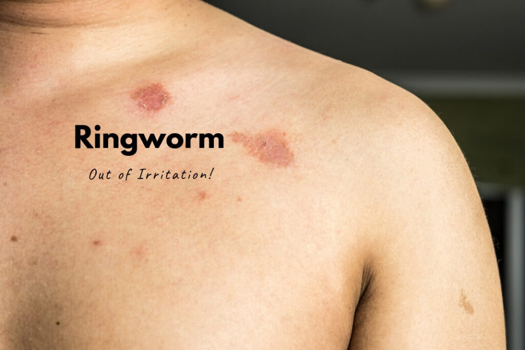 Ringworm