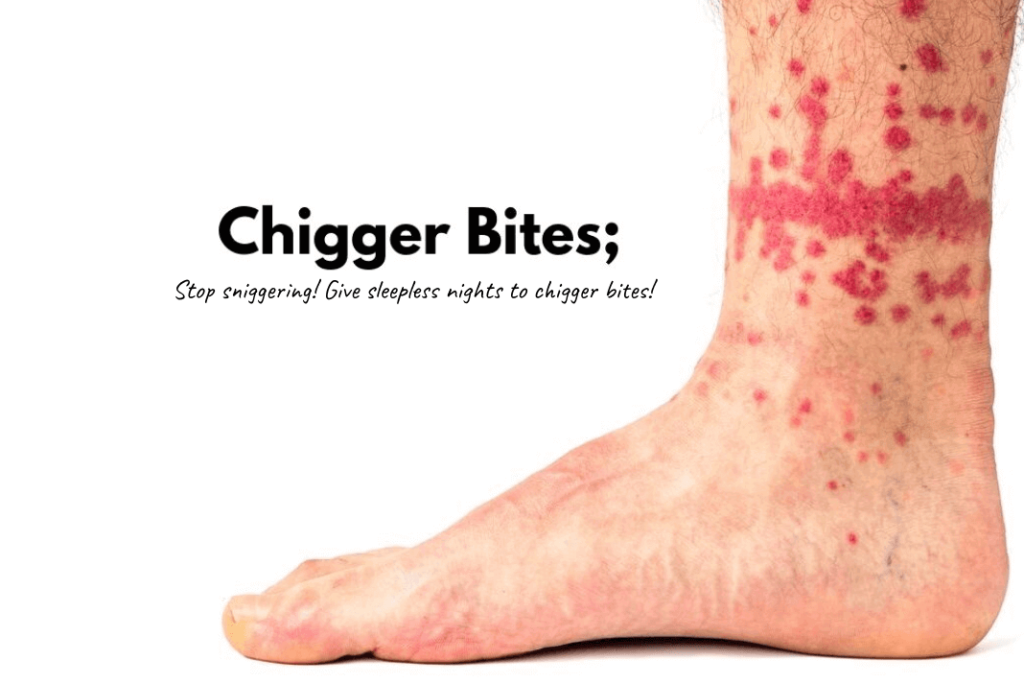 chigger bites