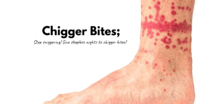 chigger bites