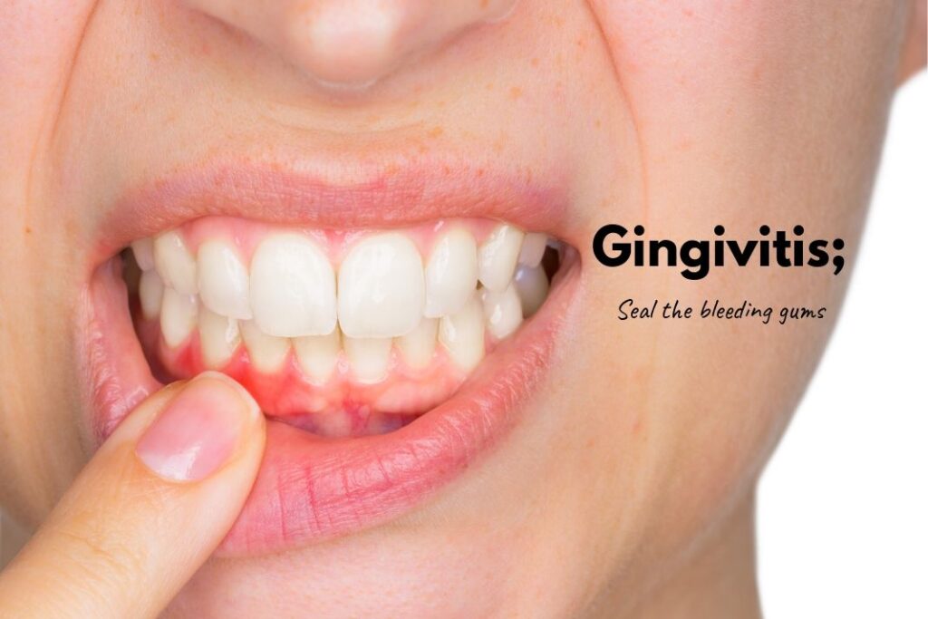 how to cure gingivitis