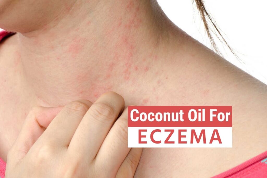 Coconut Oil for Eczema