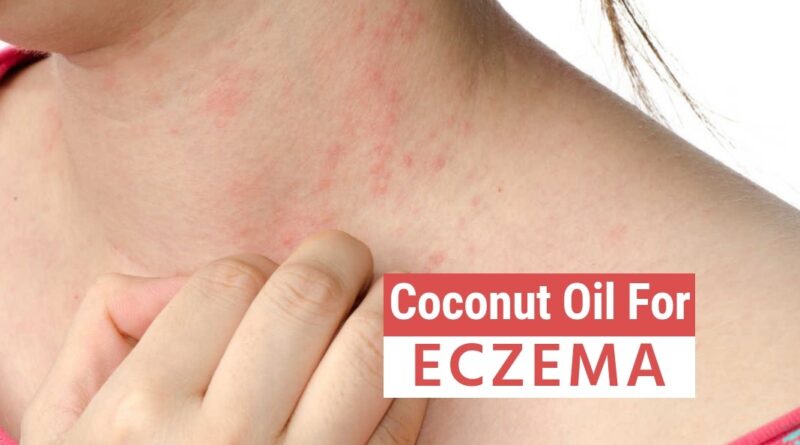 Coconut Oil for Eczema