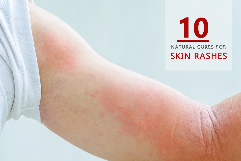 Home Remedies for Skin Rashes