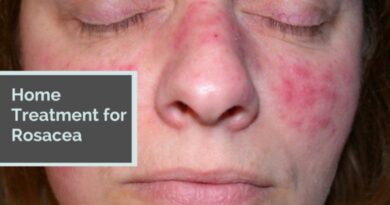 Home Treatment for Rosacea