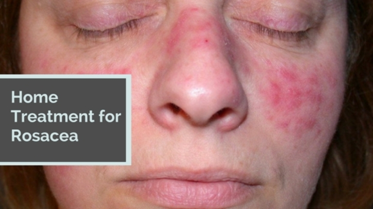 Home Treatment for Rosacea