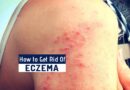 How to Get Rid of Eczema