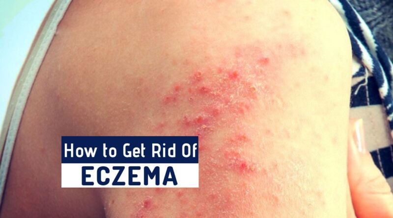 How to Get Rid of Eczema