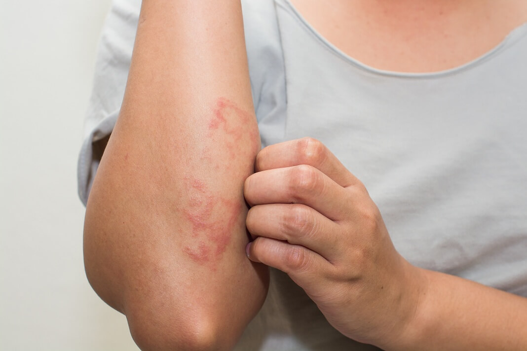 Real Cause of Eczema