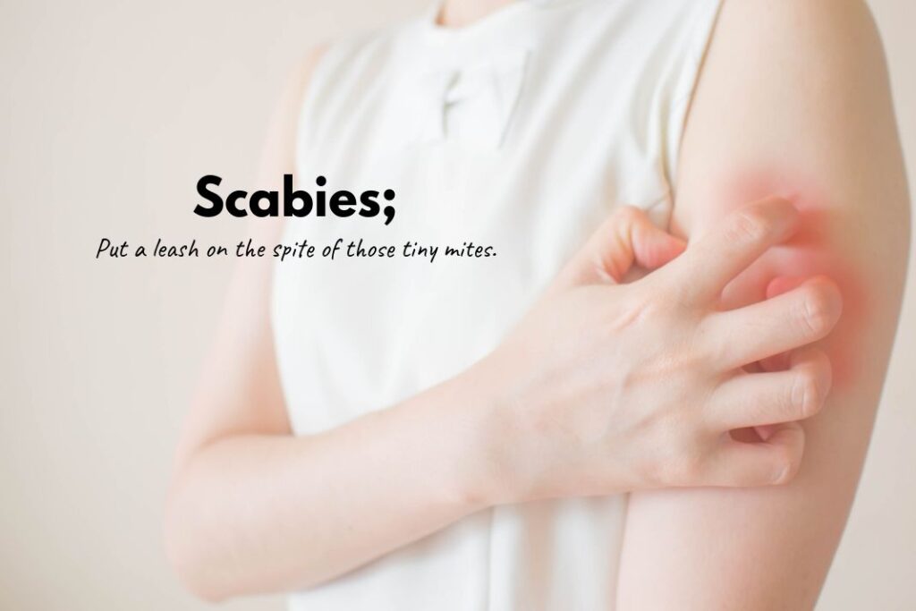 Scabies