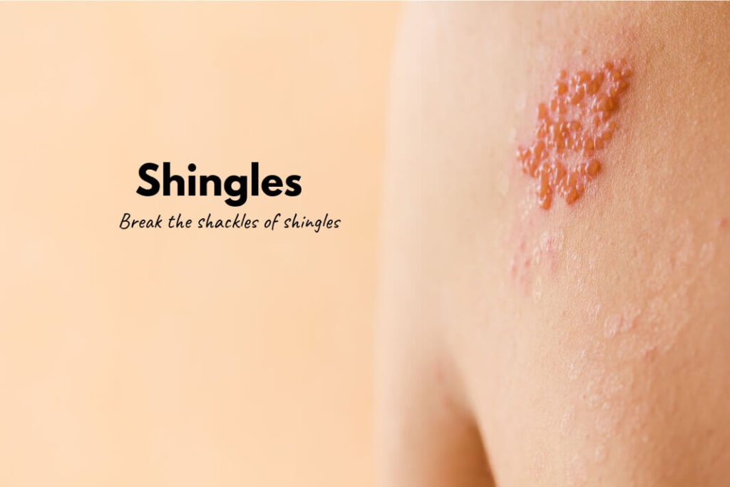 Shingles