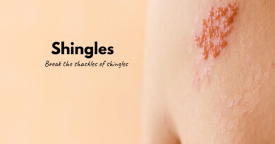 Shingles